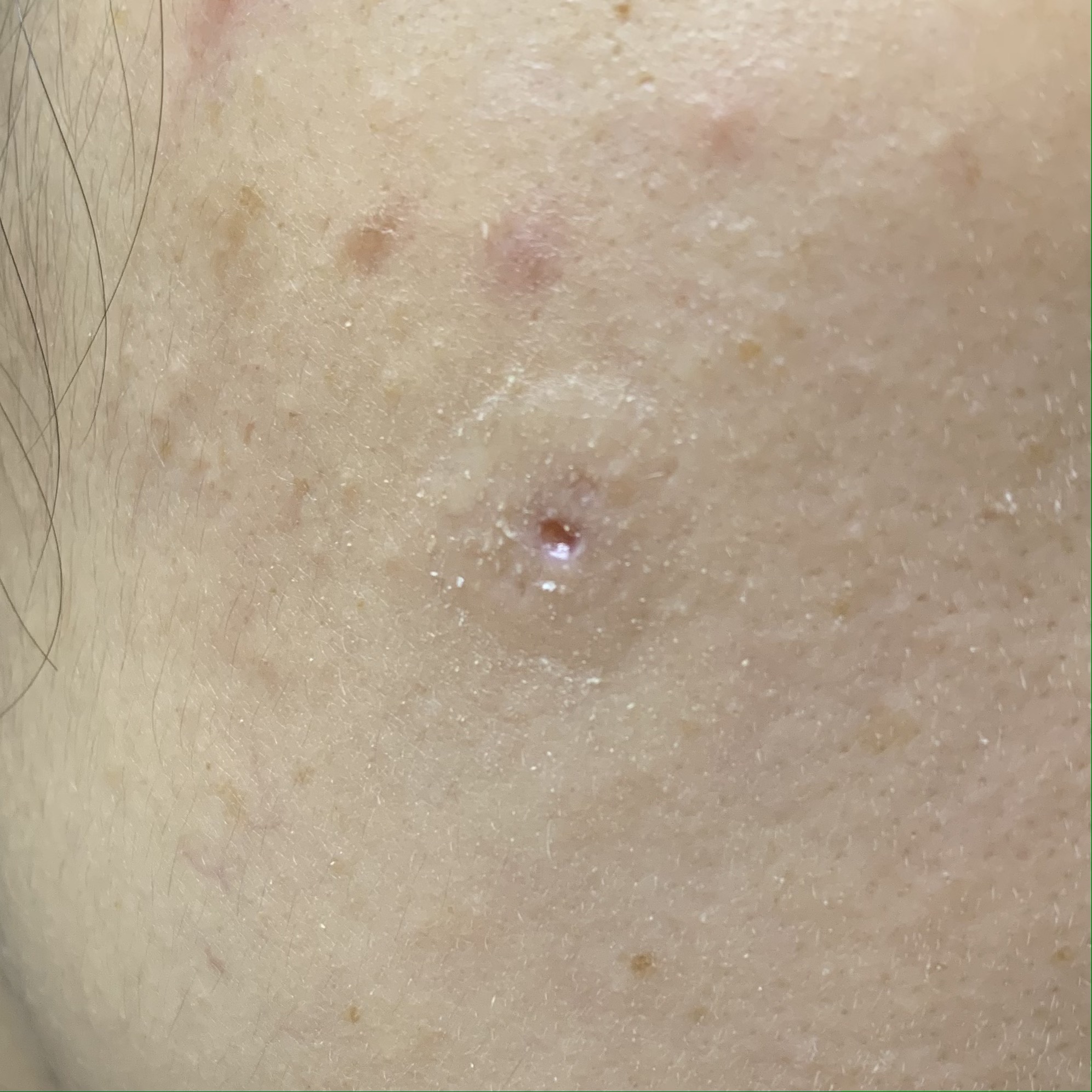 피지낭종 수술7일차