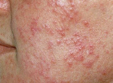 민감성 피부를 위한 항염 식단