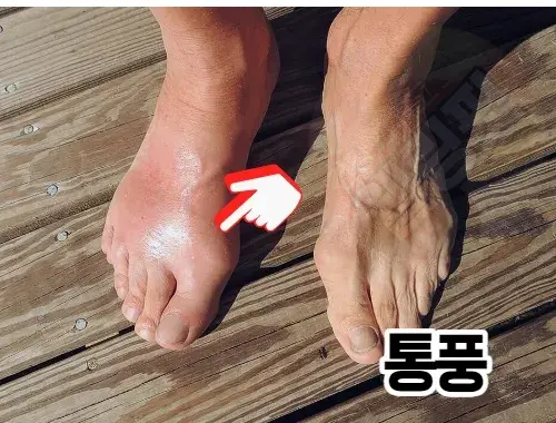 발등-통증을-일으키는-통풍