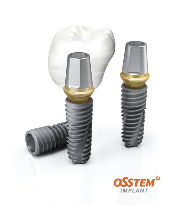 임플란트 의료보험적용대상