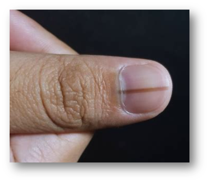 손톱 검은 세로줄1