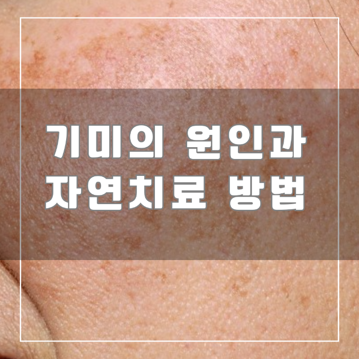 기미 원인과 자연치료