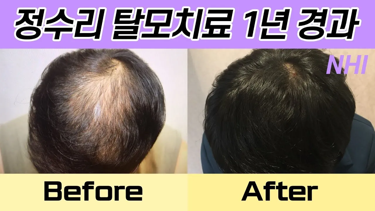 정수리가 아픈 이유와 완화하는 방법_3