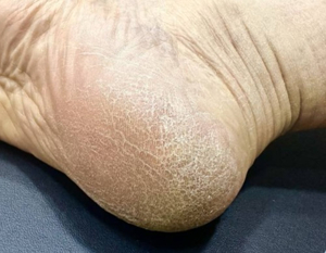 발바닥갈라짐