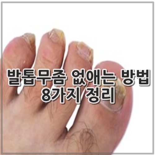 발톱무좀 없애는 방법 8가지 정리