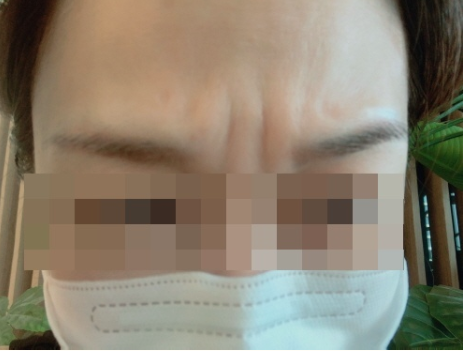이마 미간 보톡스 후기1
