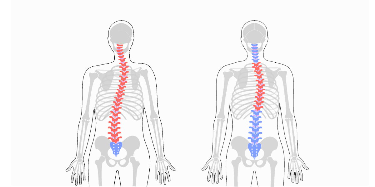 척추측만증 원인과 증상