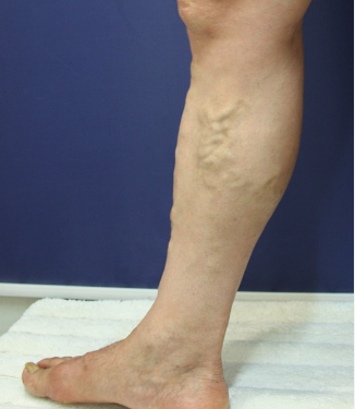 하지 정맥류 사진