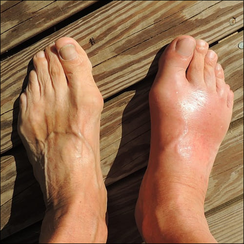 통풍에 걸린 발