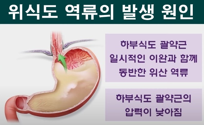 위식도 역류 발생원인
