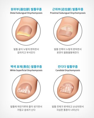 발톱무좀약