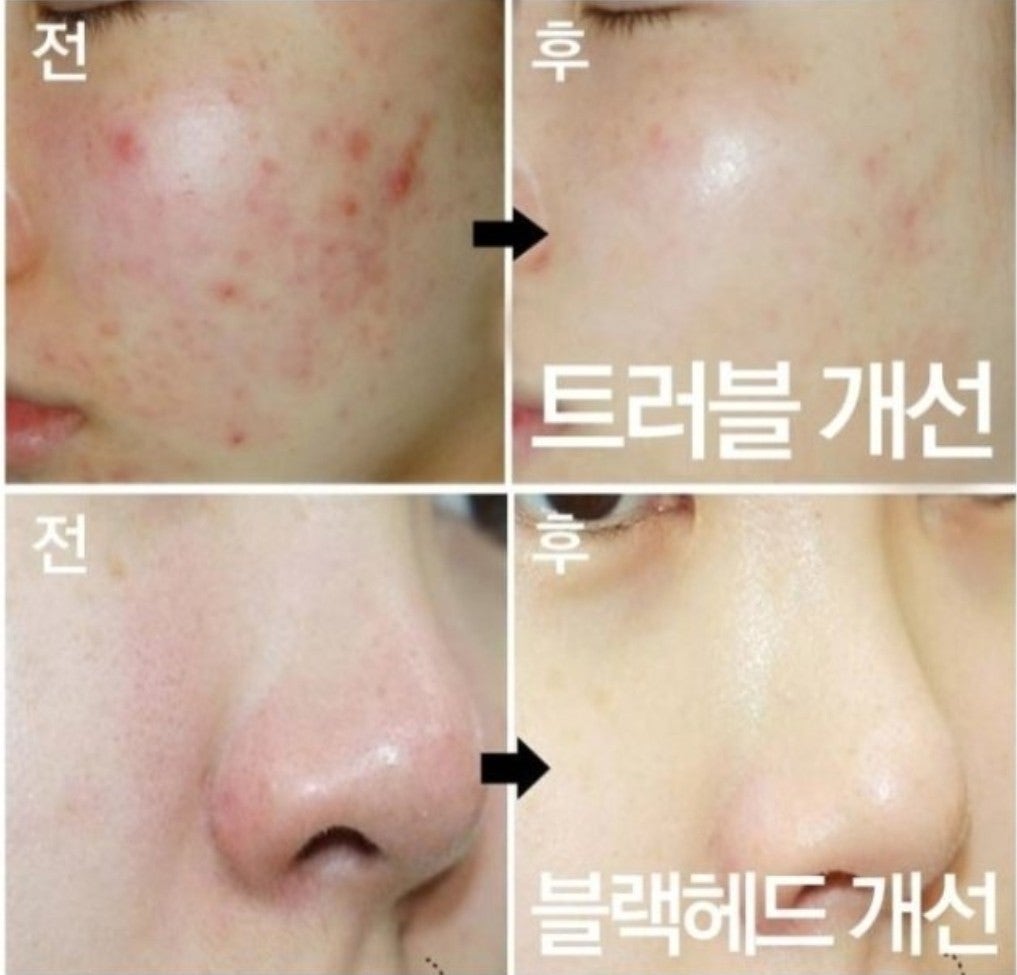 트러블이 있는 분의 에끌라뒤땅 버블클렌져 사용 전.후 임상 사진
