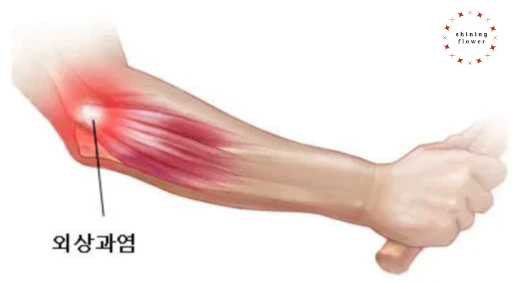 테니스엘보 그림-나무위키 참조