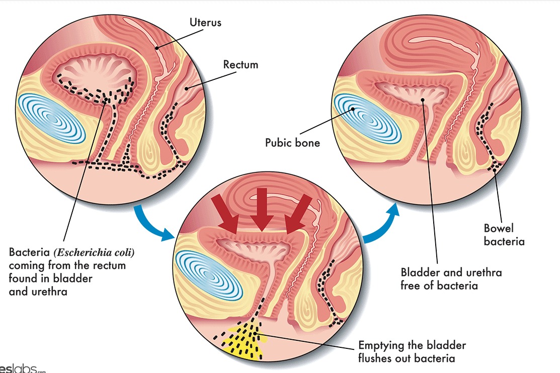 급성 방광염 증상, 원인, 치료 완전 정복