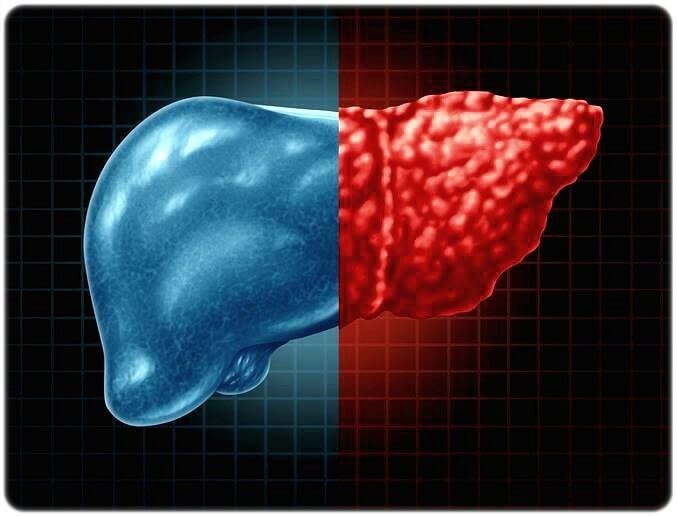 간암 초기증상 원인 진단 치료 예방 생존율
