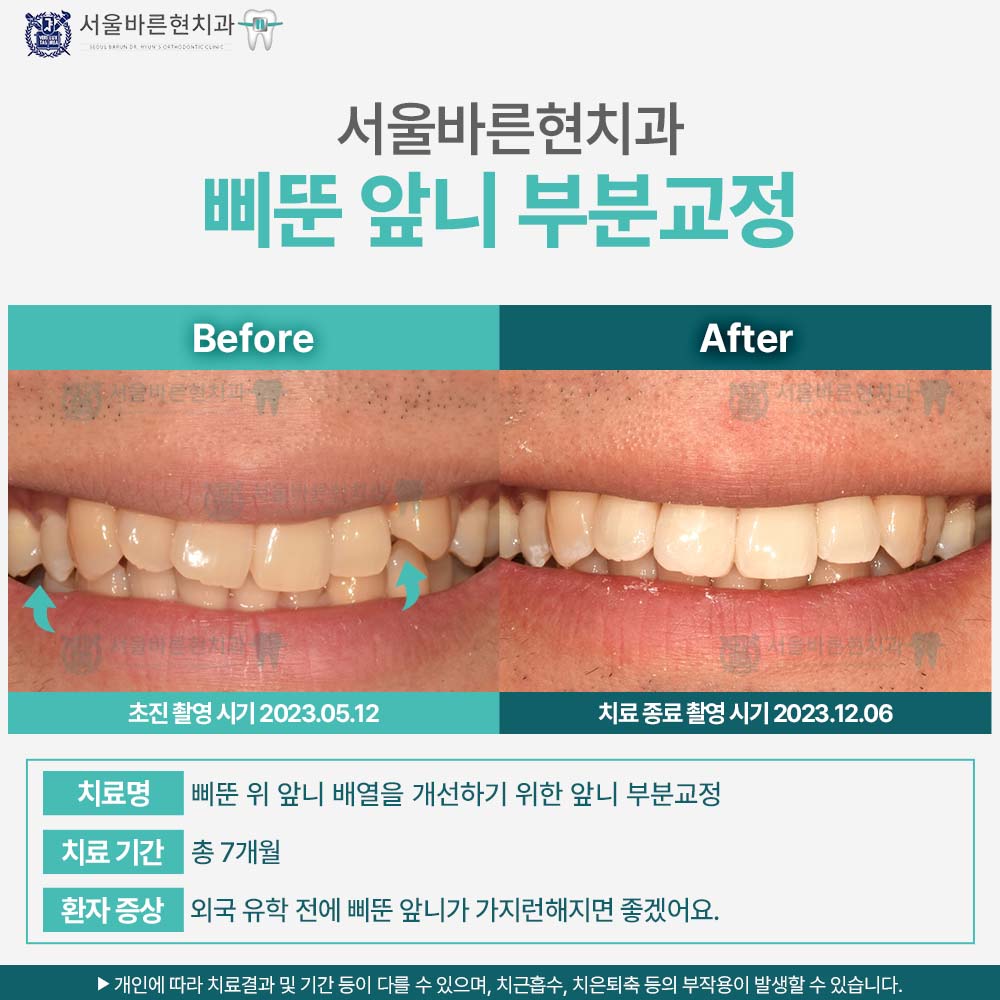 마린시티앞니교정