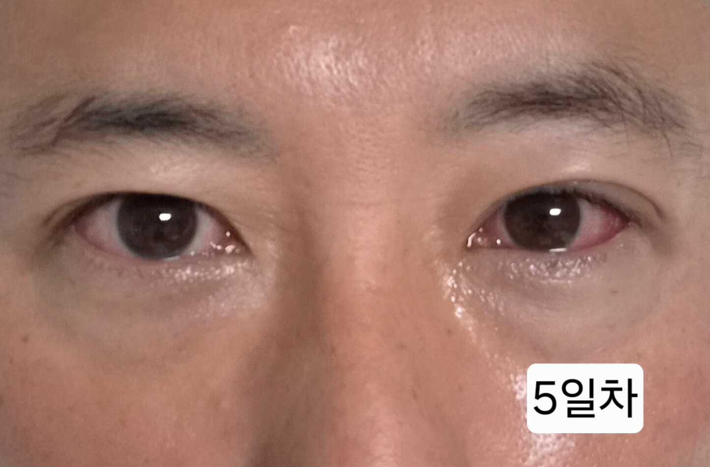 유행성각결막염 눈병 초기증상부터 12일차 치료 기록(진행 중)