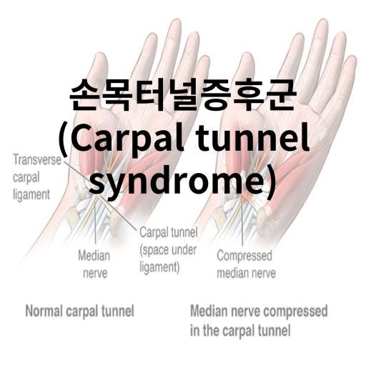 손목터널증후군을 보여주는 의학적 사진