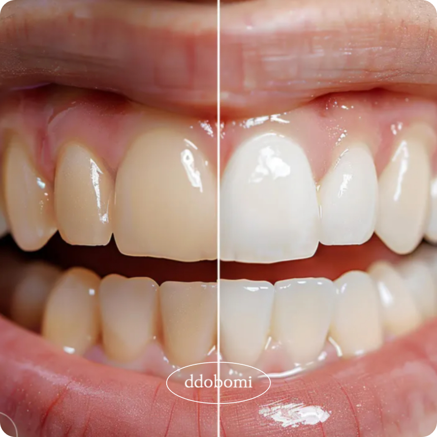 치아 변색의 원인, 음식, 그리고 효과적인 치료방법