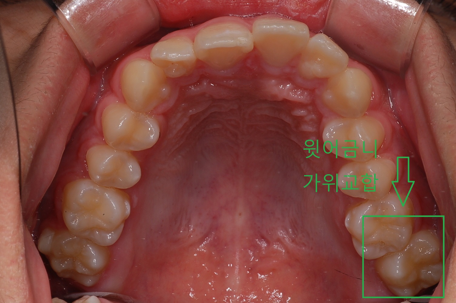 부정교합 가위교합 과개교합 치아교정1