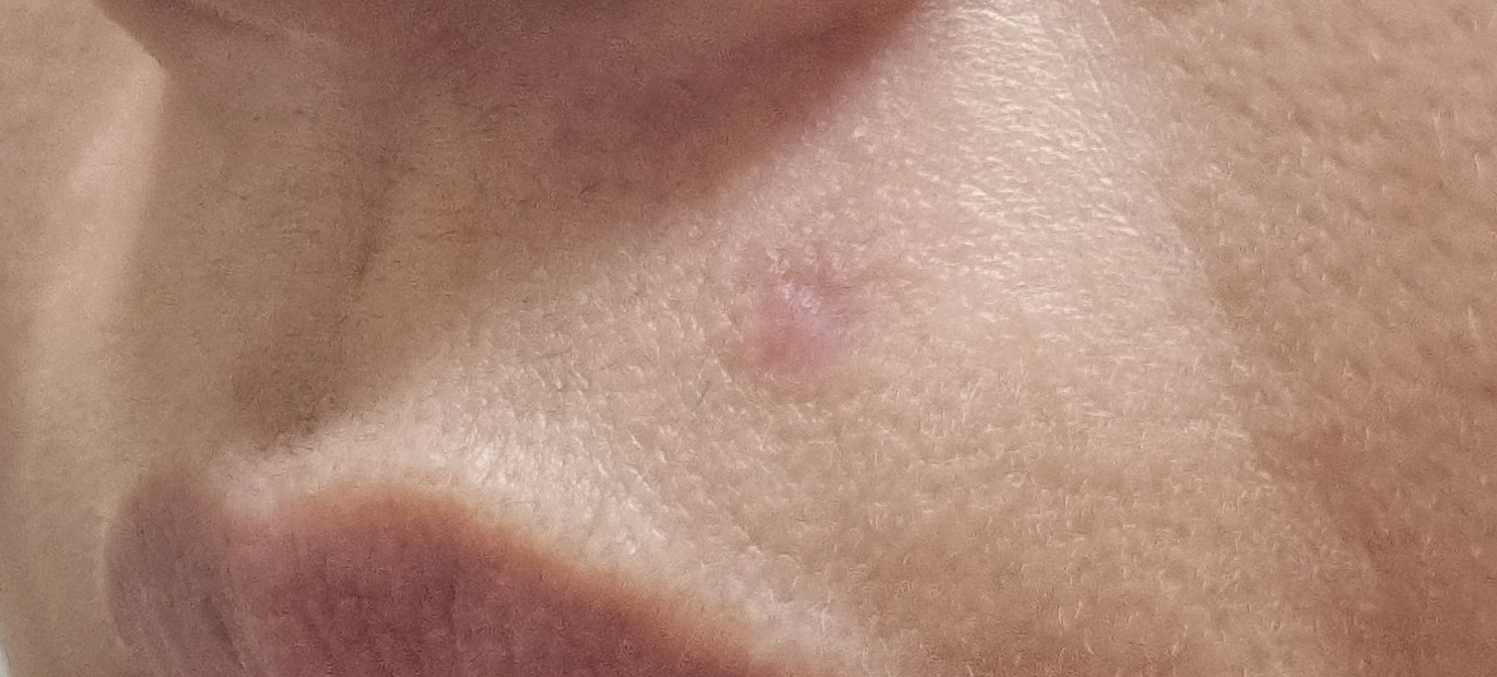 얼굴 피지낭종 제거 후기