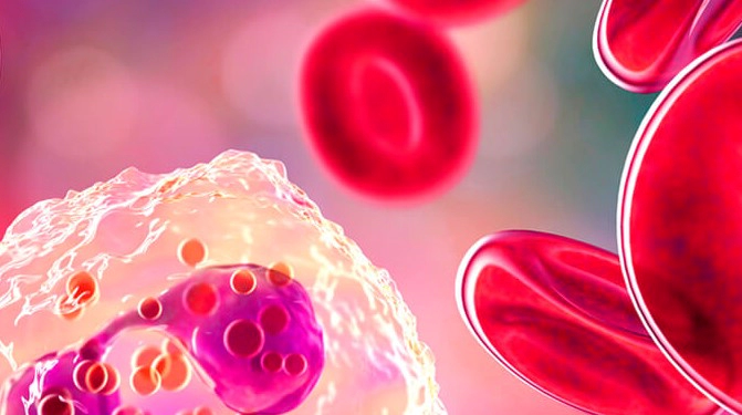 골수형성이상증후군 증상 진단기준 및 MDS 치료 방법 정리