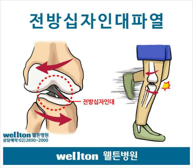 무릎십자인대파열