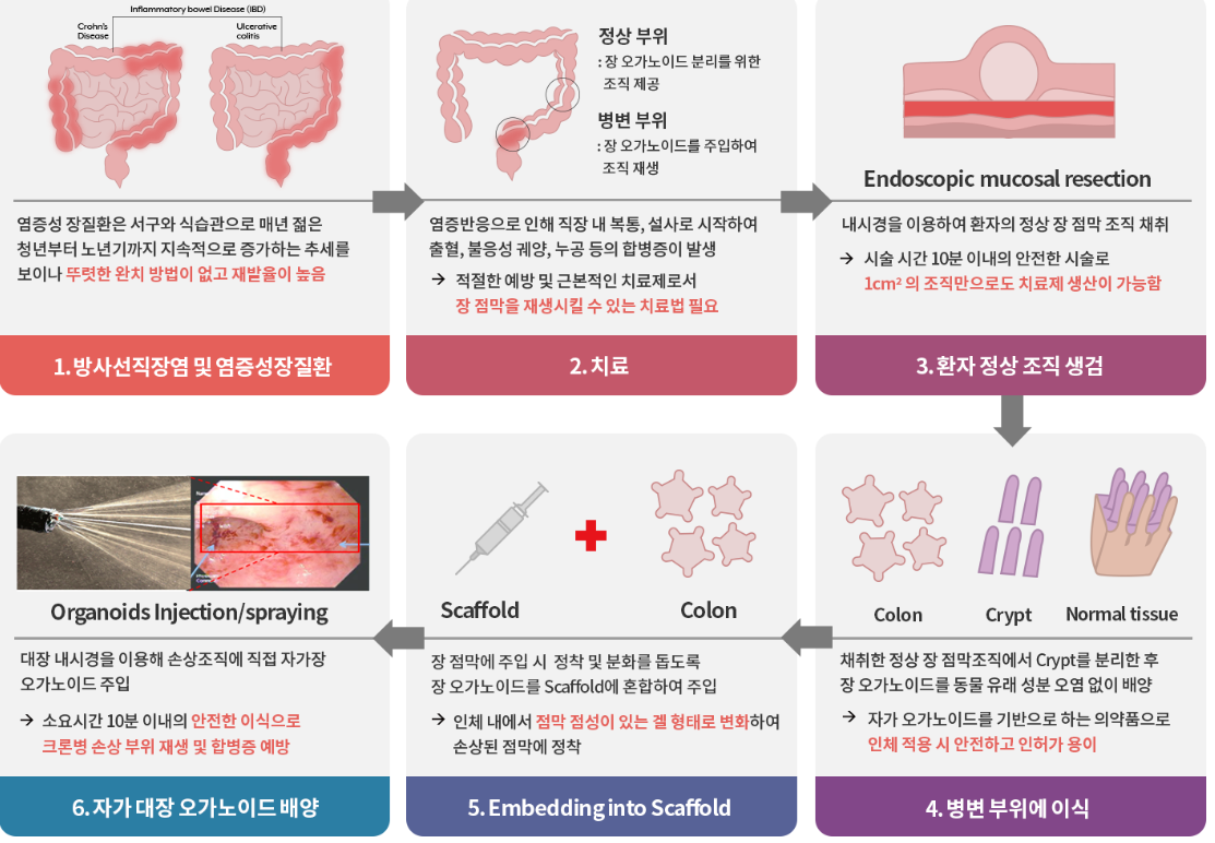 오가노이드사이언스의 대장 크론병 손상 부위 재생 치료 과정