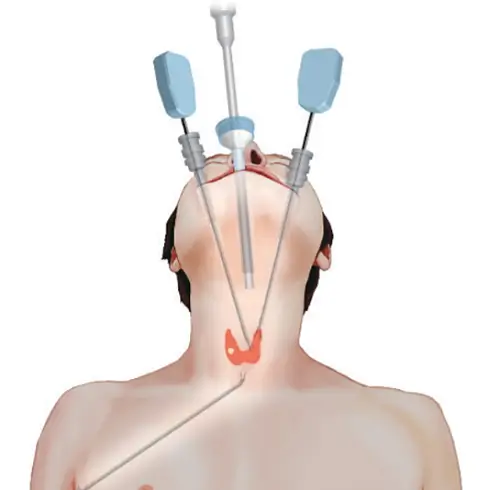 갑상선암 내시경 수술 방법 중 하나