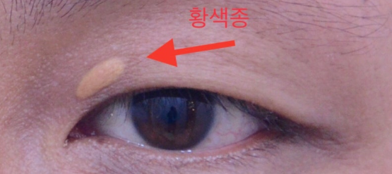 눈 구석에 노란색의 작은 혹
