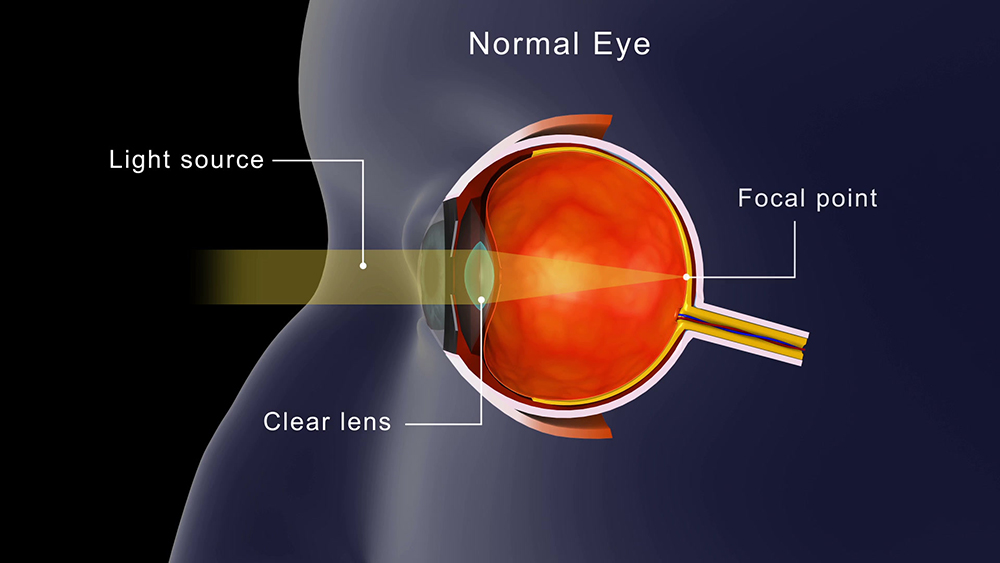 백내장 수술 비용