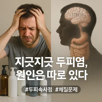 * 이미지 프롬프트: 화면을 반으로 분할한 이미지. 왼쪽에는, 다양한 종류의 샴푸 병들 앞에서 한 인물이 머리를 감싸 쥐고 좌절하는 모습. 오른쪽에는, 동일 인물의 머리 실루엣 위에 스트레스와 식습관을 상징하는 뇌와 소화기관의 이미지가 희미하게 겹쳐 보이는 모습. 전체적으로 깨끗하고 세련된 느낌의 고품질 사진.
* 썸네일 텍스트(제목): 지긋지긋 두피염, 원인은 따로 있다
* 해시태그: #두피속사정 #체질문제