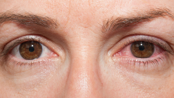 눈 충혈 이미지