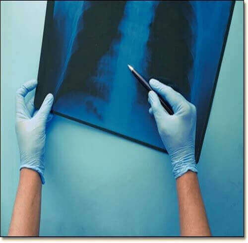 왼쪽 밑가슴 통증 진단 및 치료, 엑스선 진단