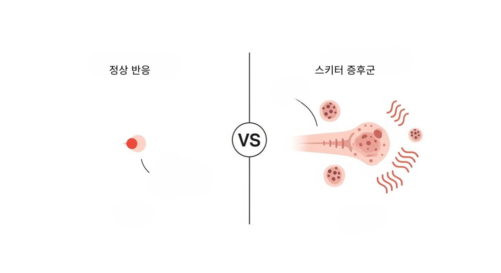 모기알러지