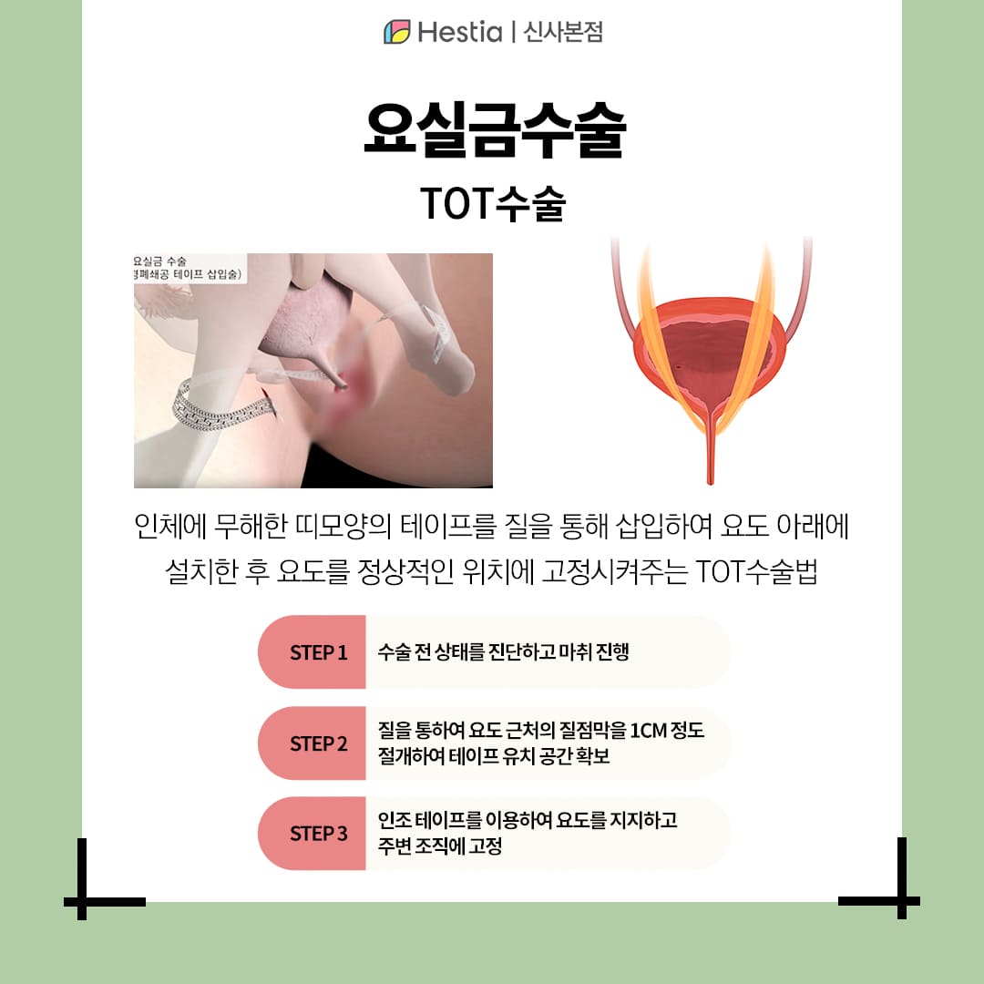요실금수술이 필요한 경우는?