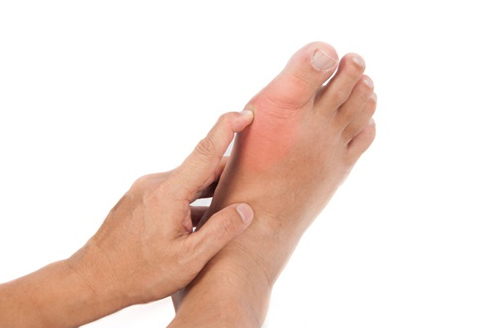 서구화된 음식으로 황제병이라 불리는 통풍원인