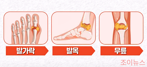 통풍의 부위별 증상, 발가락/발목/무릎