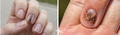 손톱 검은 세로줄 울퉁불퉁 생기는 이유 4가지 흑색종 증상 및 손톱 세로줄 없애기 영양제 추천 건강 상태 체크법