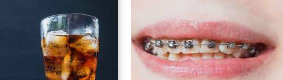 탄산음료 및 치아를 보여주는 사진