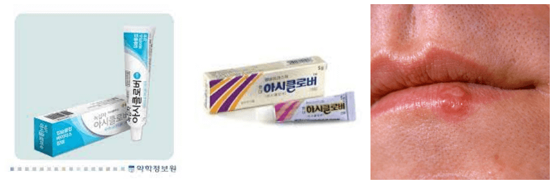 아시클로버 연고, 입술 포진 사진