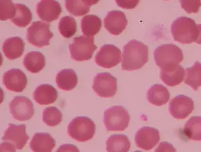 신장이 안좋으면 나타나는 증상 16