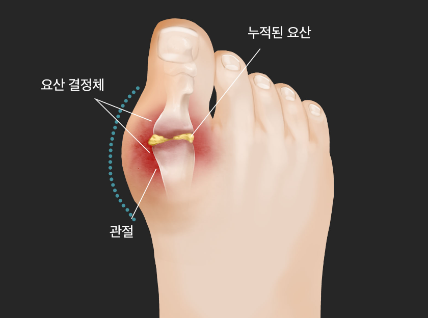 통풍 원인