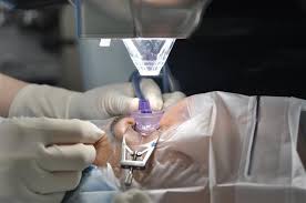 라식과 라섹 차이점