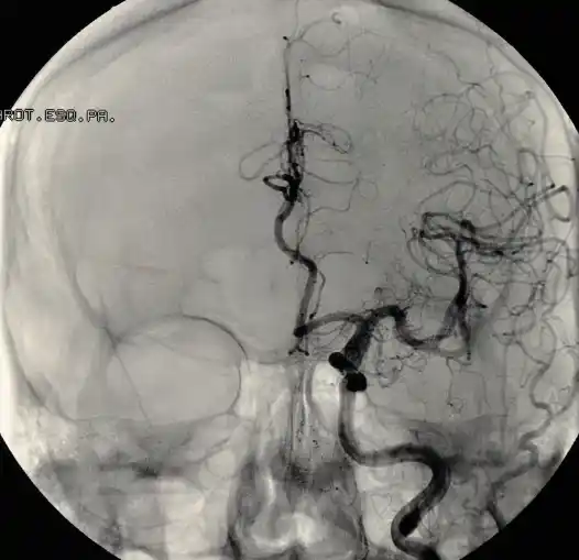 뇌경색 전조증상 및 치료 방법&amp;#44; 좋은 음식 알아보기