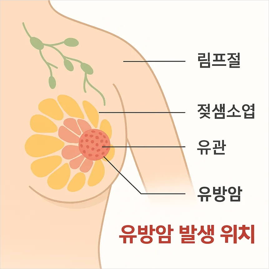 유방암 초기증상