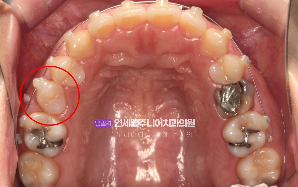 MTA 교정 중 회전된 상악 작은어금니의 배열이 개선되는 과정