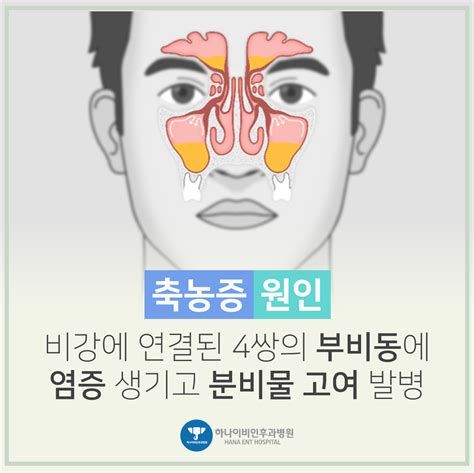 축농증