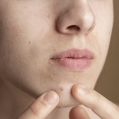 사춘기 자녀 피부 고민 해결책 - 여드름 관리 총정리