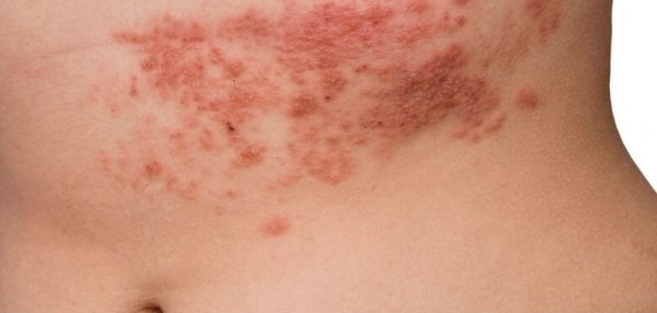 대상포진 초기 증상